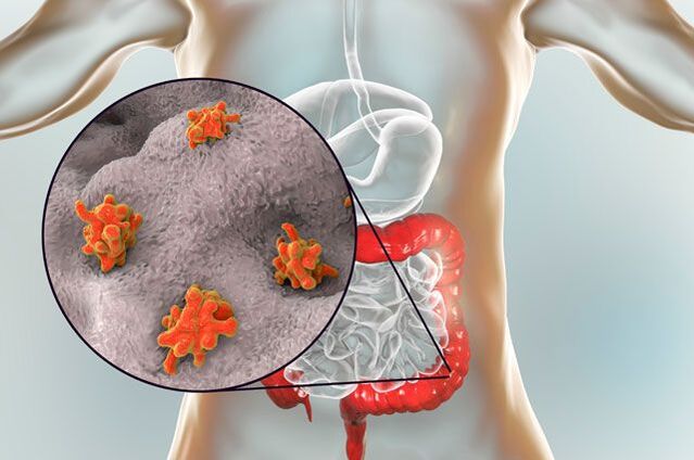 Arten von Parasiten im menschlichen Körper